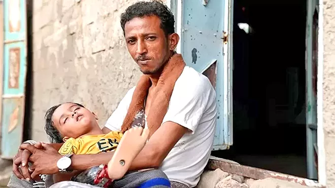 أمير يتذكر كل لحظة بعد القصف الذي أصاب ساقه، على حد قول والده 